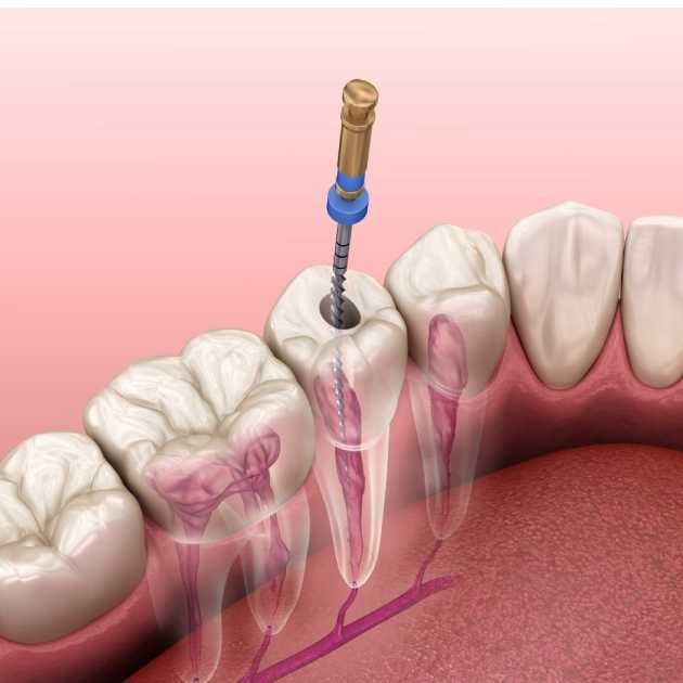 كيف نتخلص من ألم الأسنان في المنزل؟